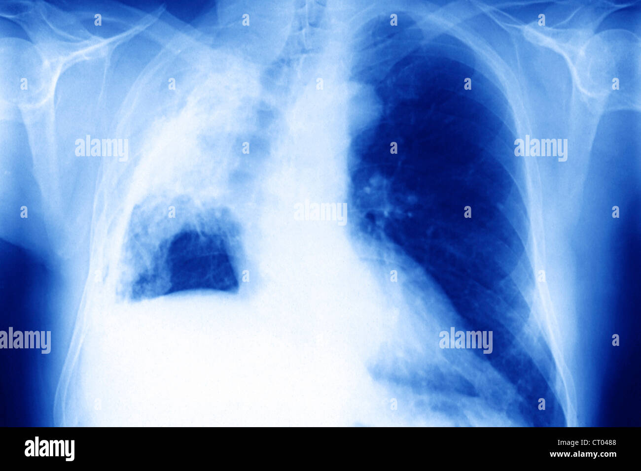 Il cancro del polmone RADIO Foto Stock