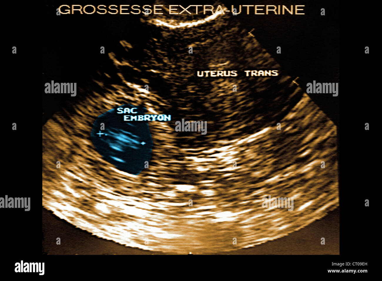 Gravidanza extrauterina SONOGRAM Foto Stock