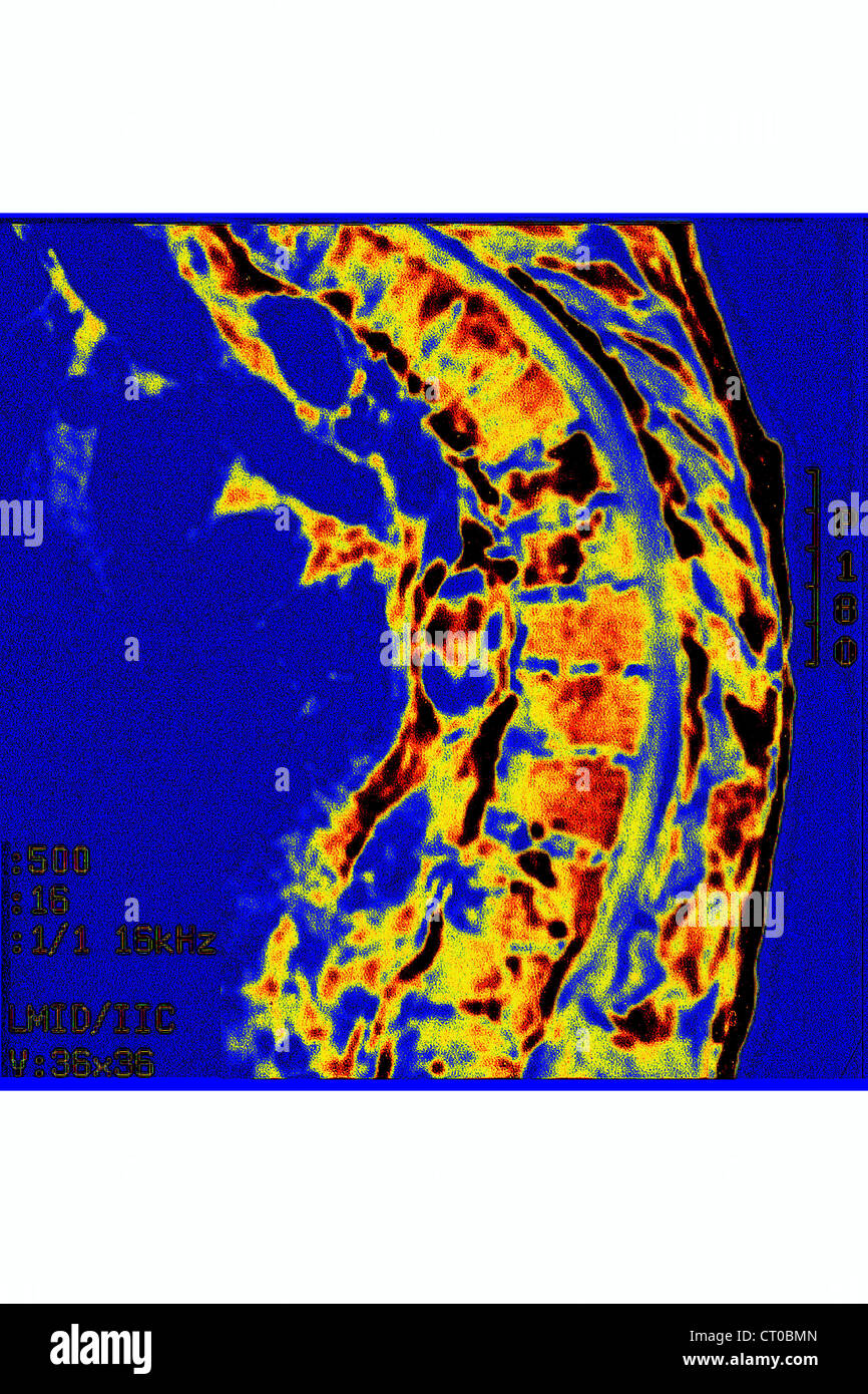 Frattura di compressione, MRI Foto Stock