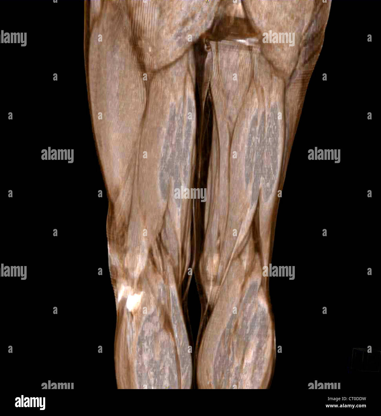 MUSCOLO, SCANSIONE Foto Stock
