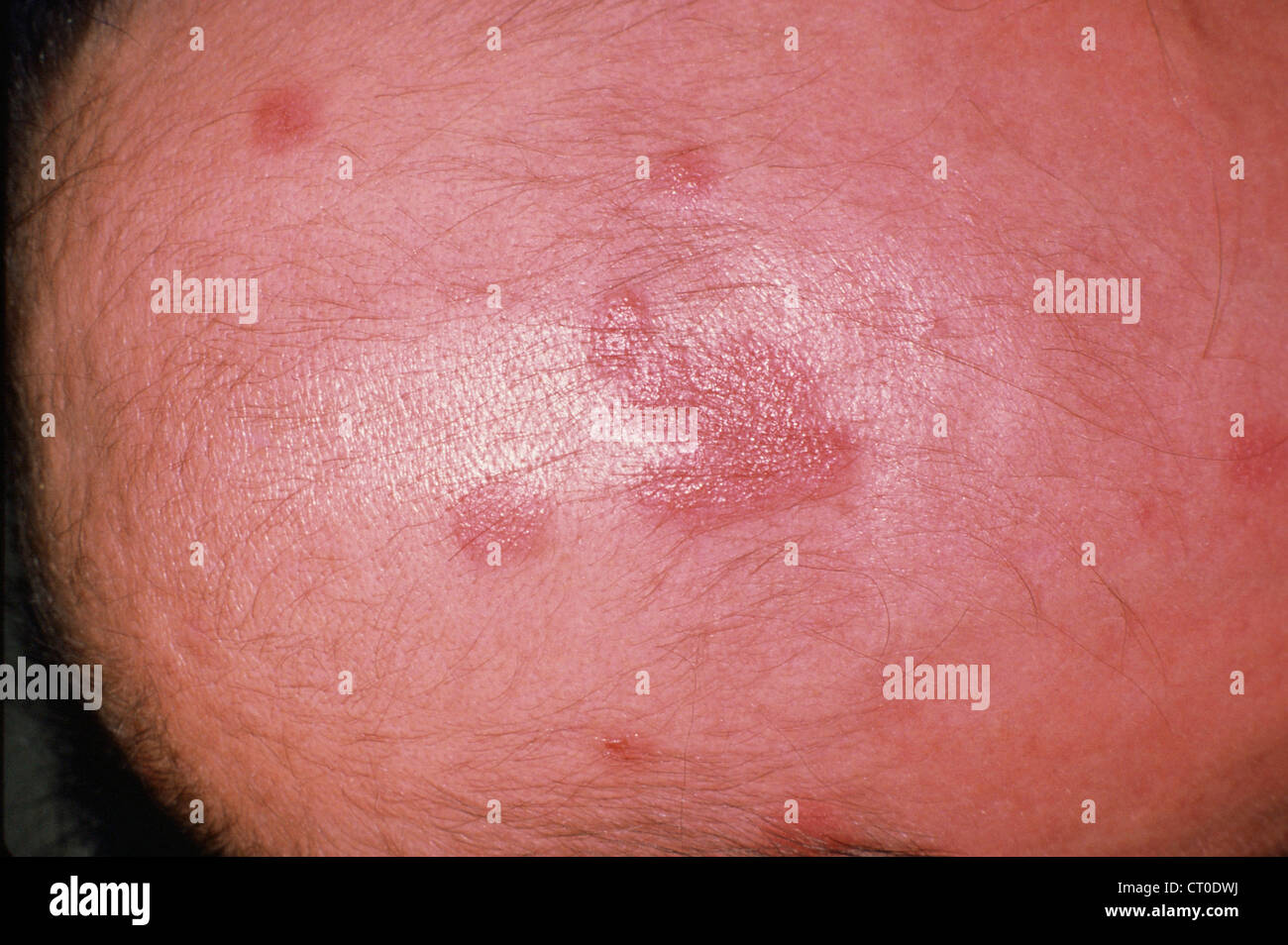 Dermatite seborroica Foto Stock