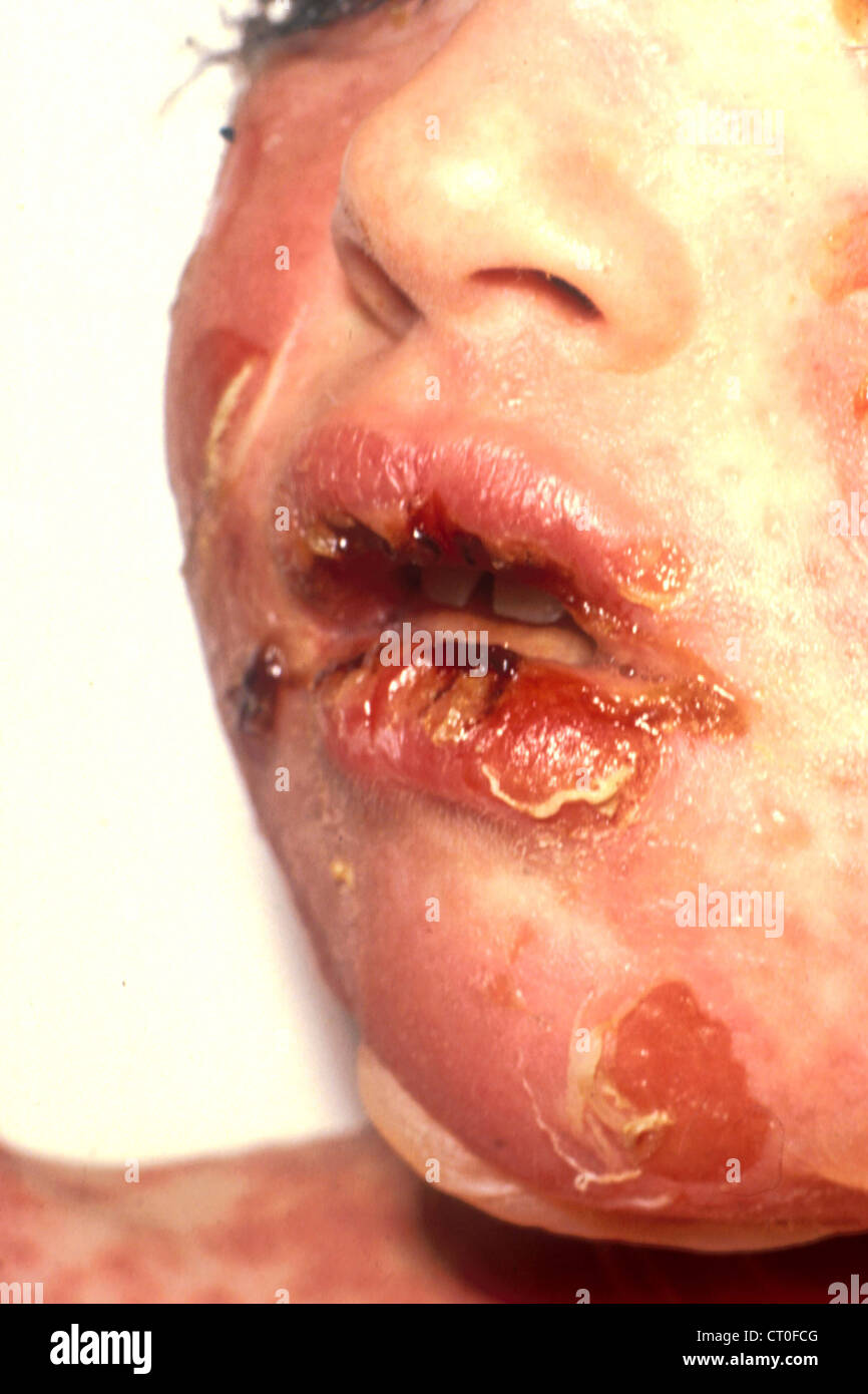 Tossico necrosi epidermica Foto Stock