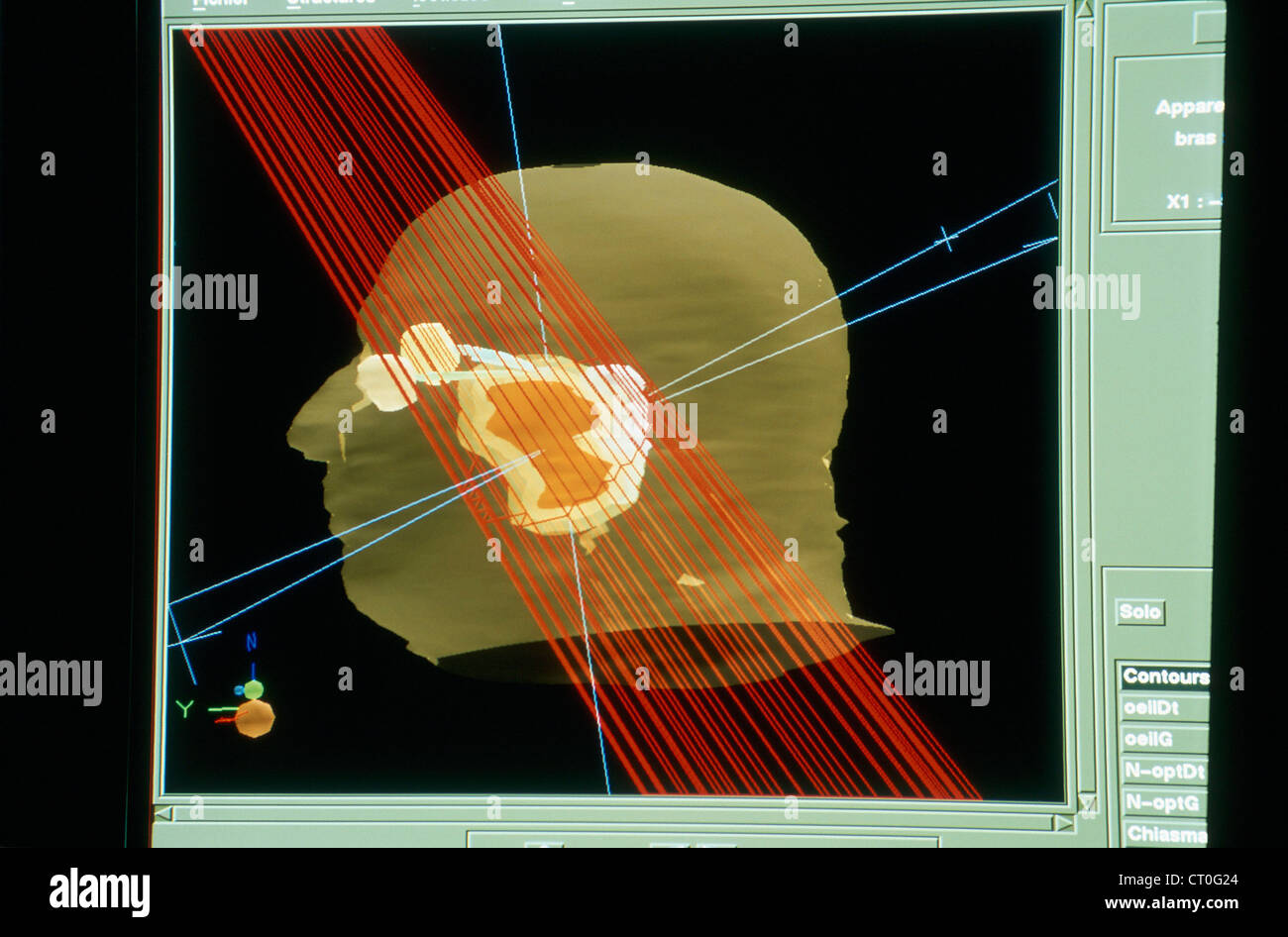 BRAIN CANCER RADIOTERAPIA Foto Stock