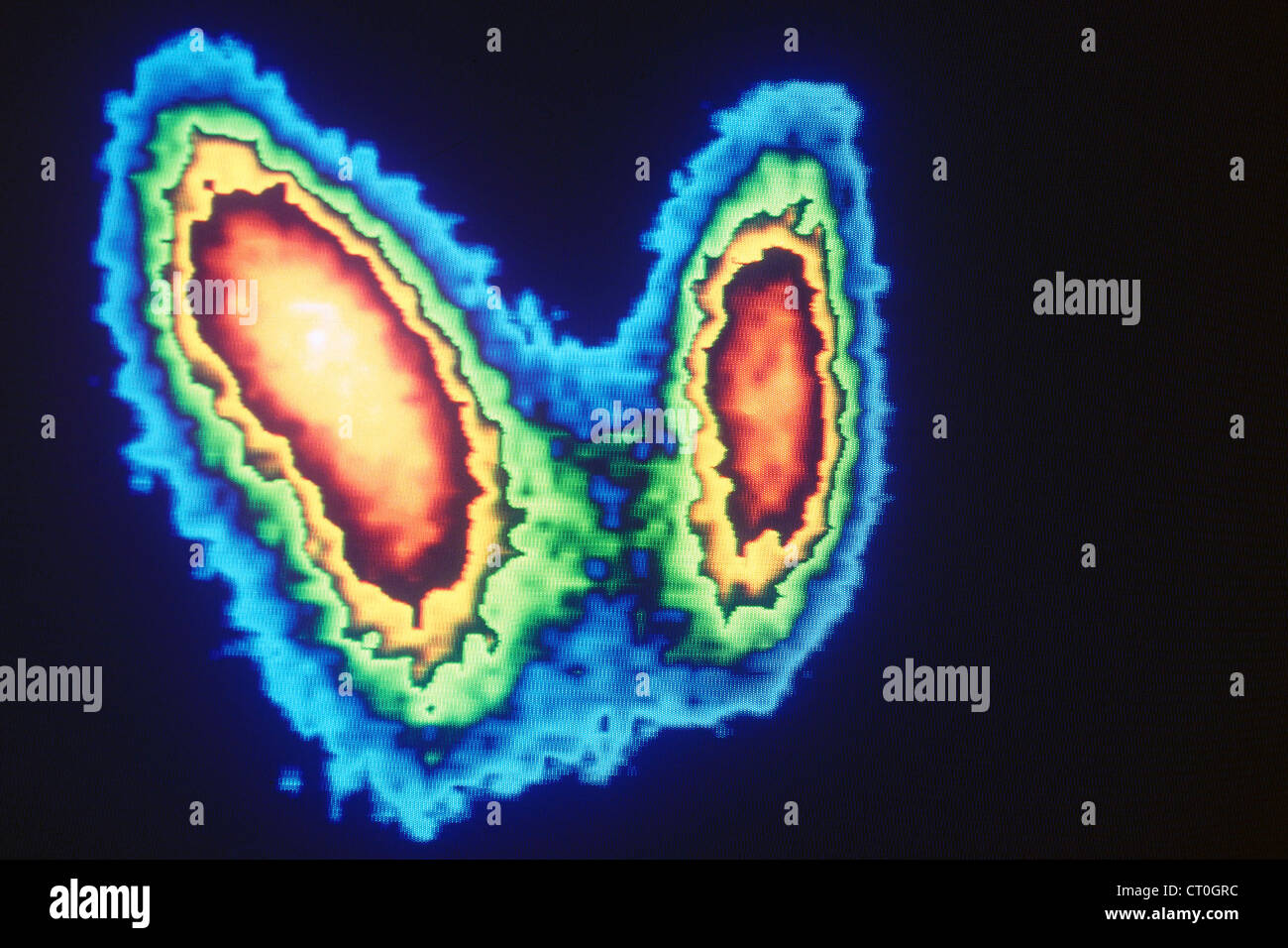 La ghiandola tiroidea, SCINTISCAN Foto Stock