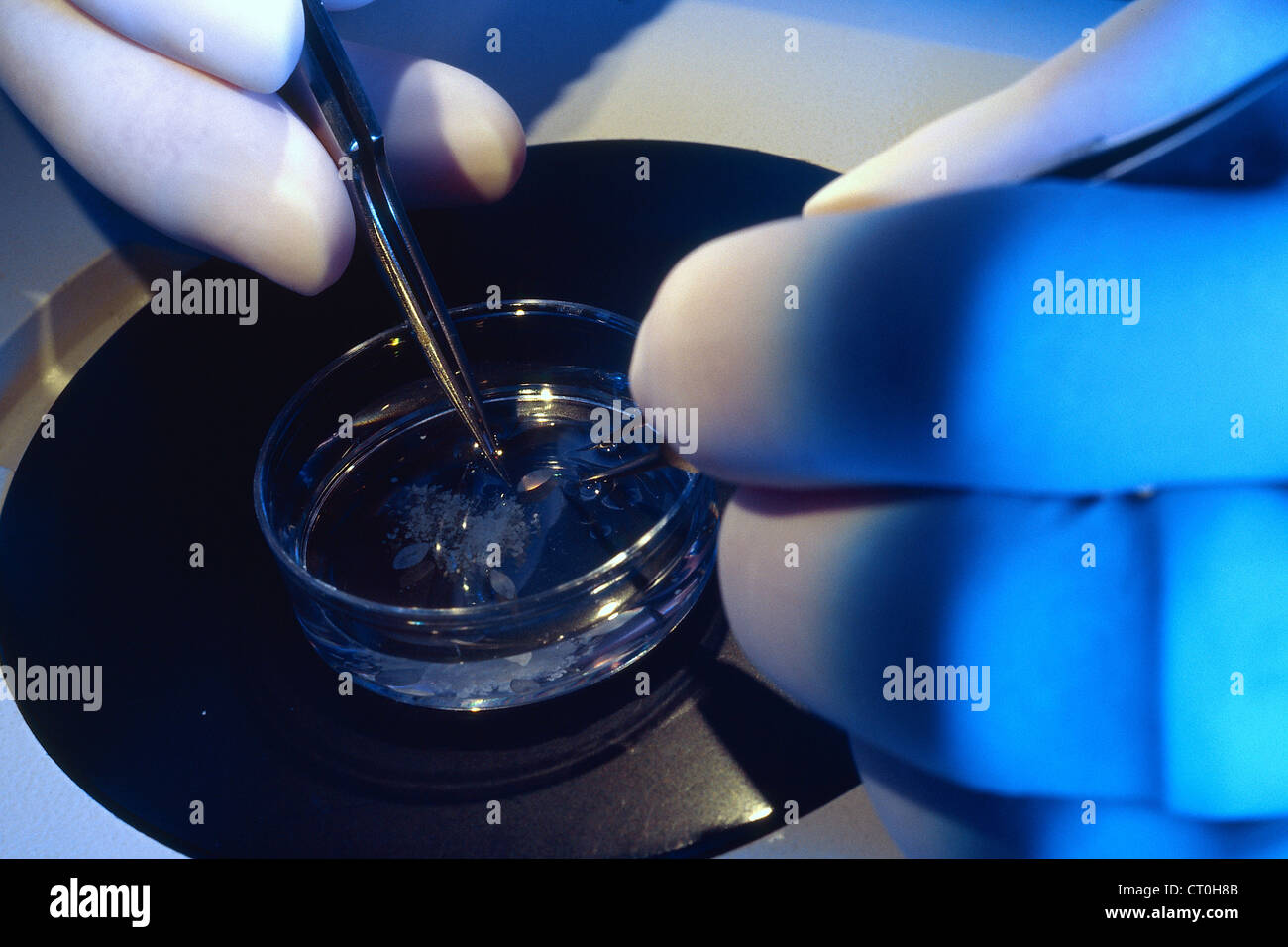 Trapianto della retina Foto Stock