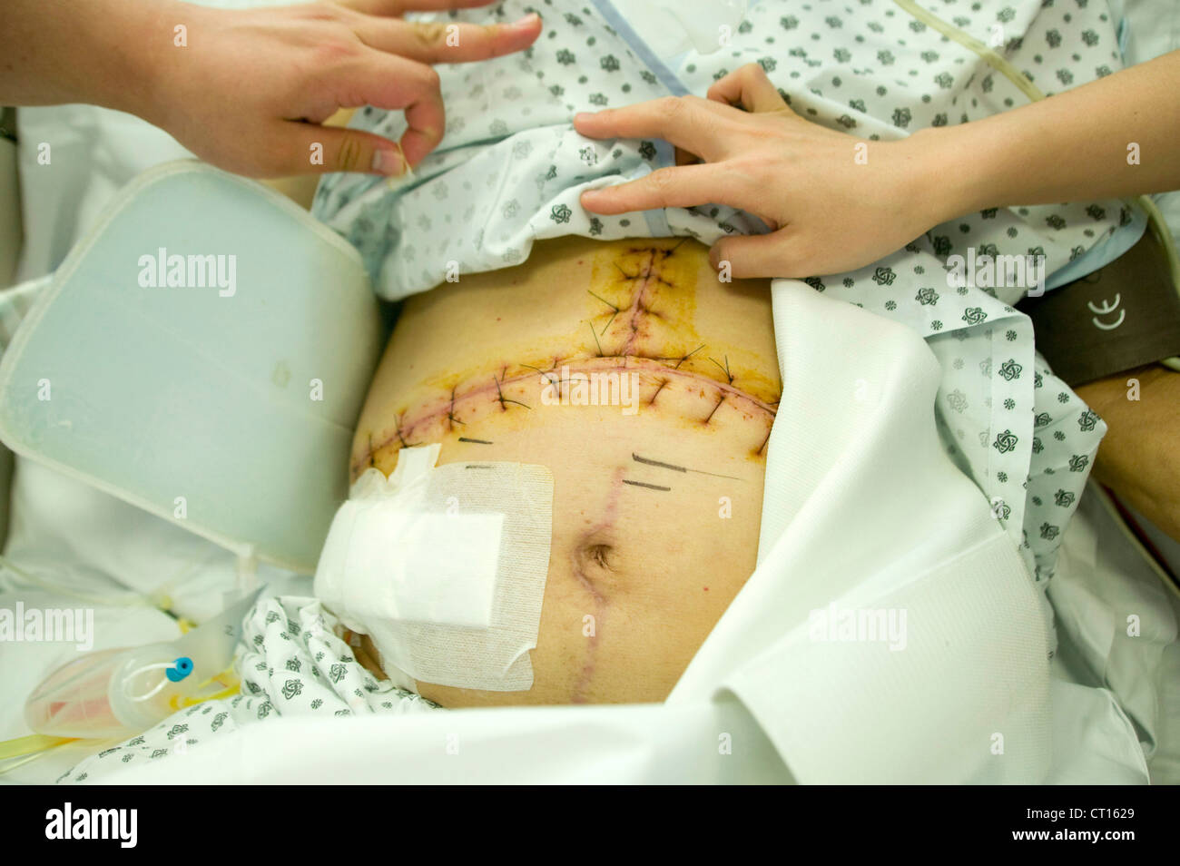 Le donne con lesioni addome Foto Stock