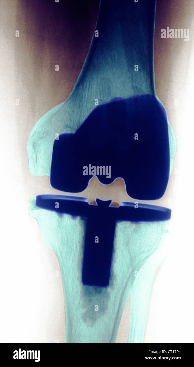 Protesi di ginocchio, RAGGI X Foto Stock