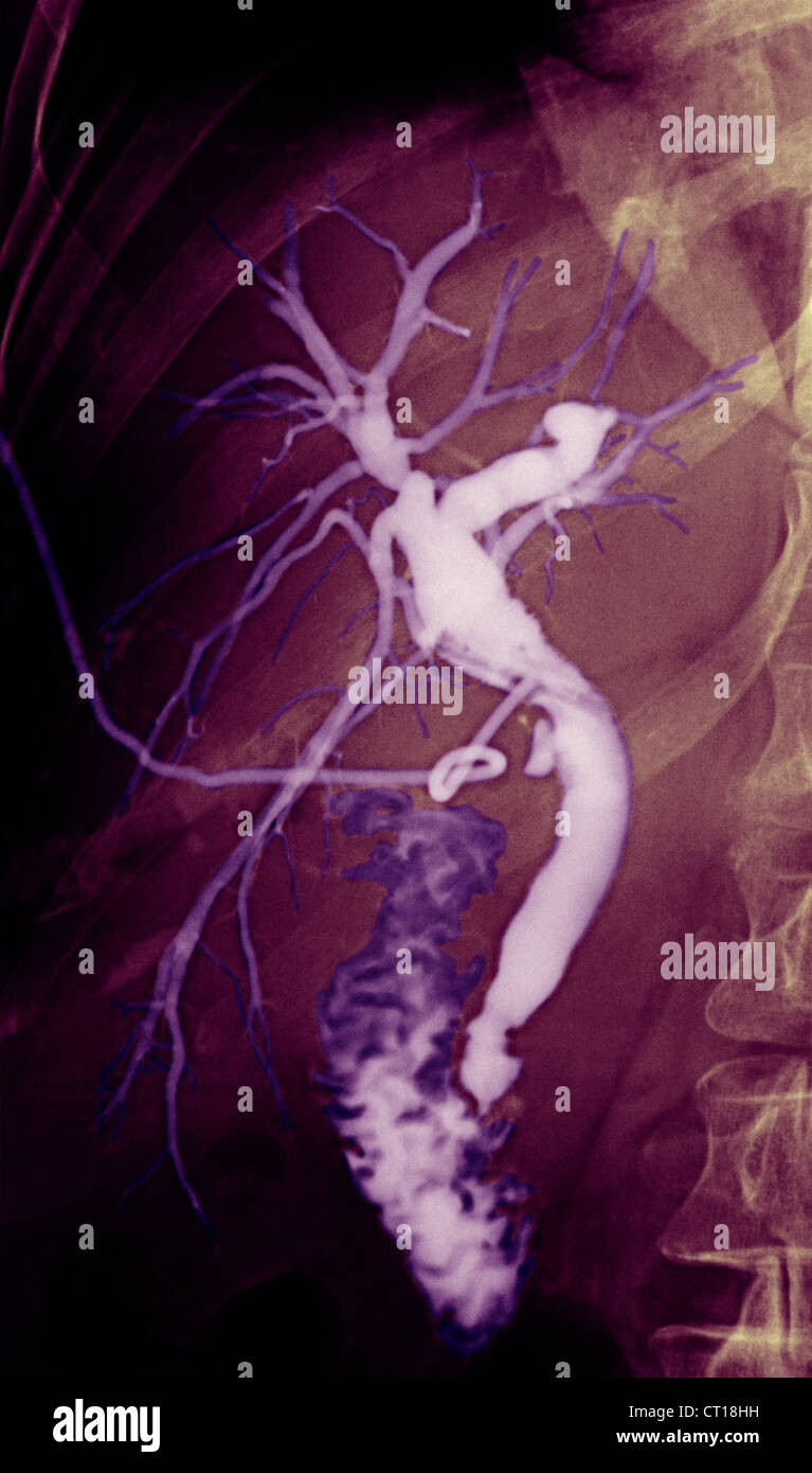 COLANGIOGRAFIA Foto Stock