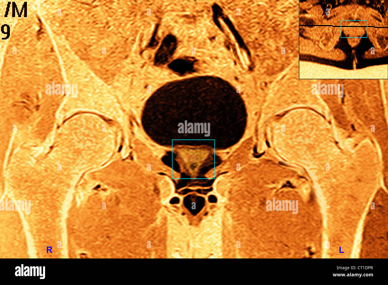 PROSTATA, MRI Foto Stock