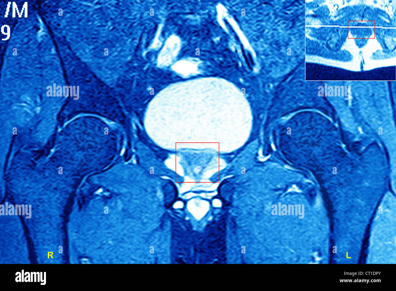 PROSTATA, MRI Foto Stock