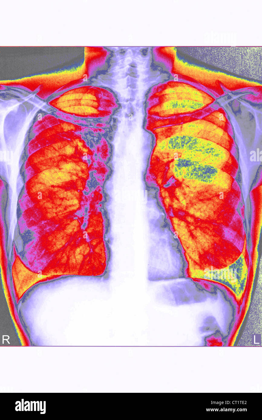 Cancro bronchiale, RAGGI X Foto Stock