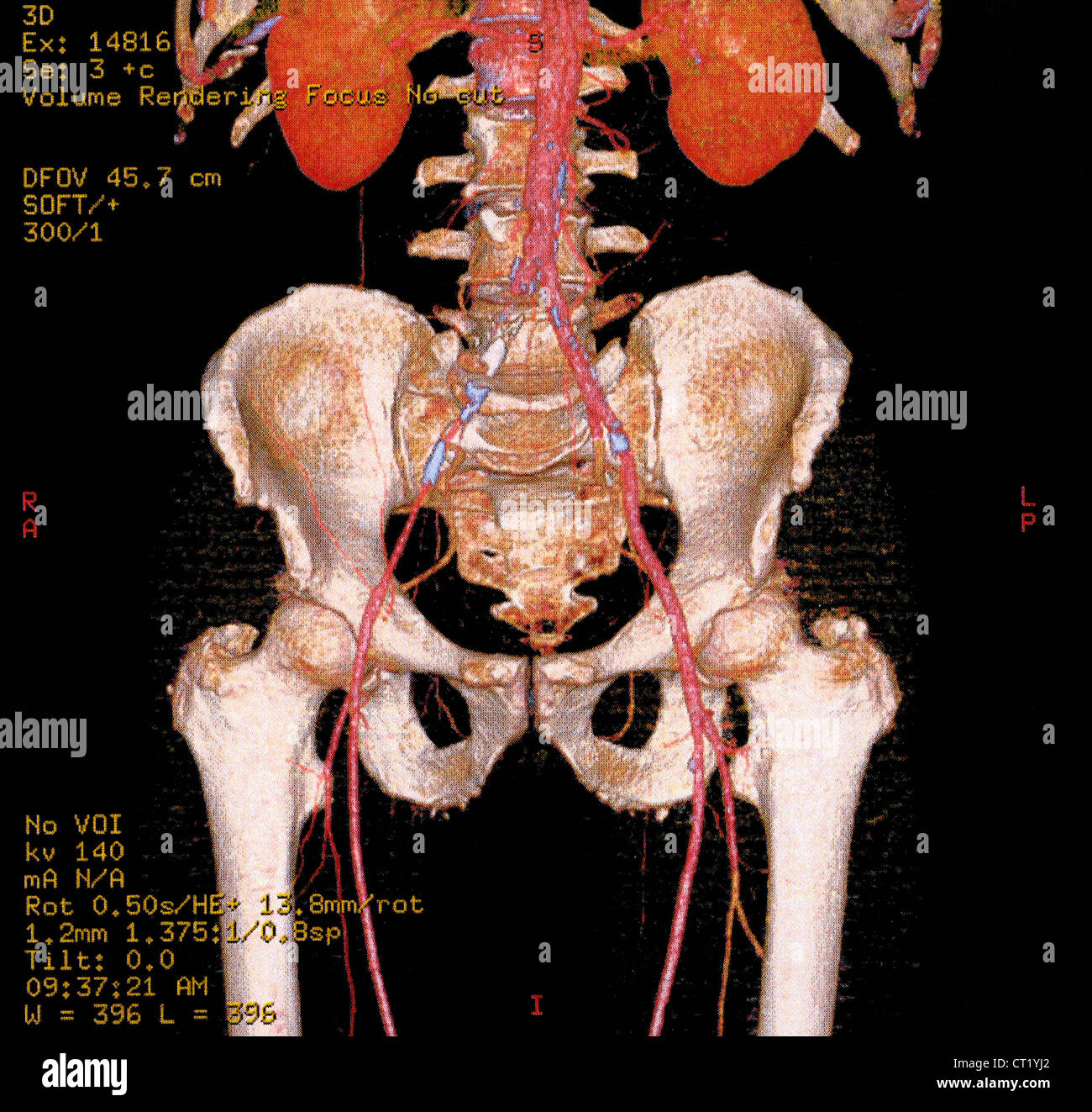 Vena Iliaca Comune Immagini e Fotos Stock Alamy