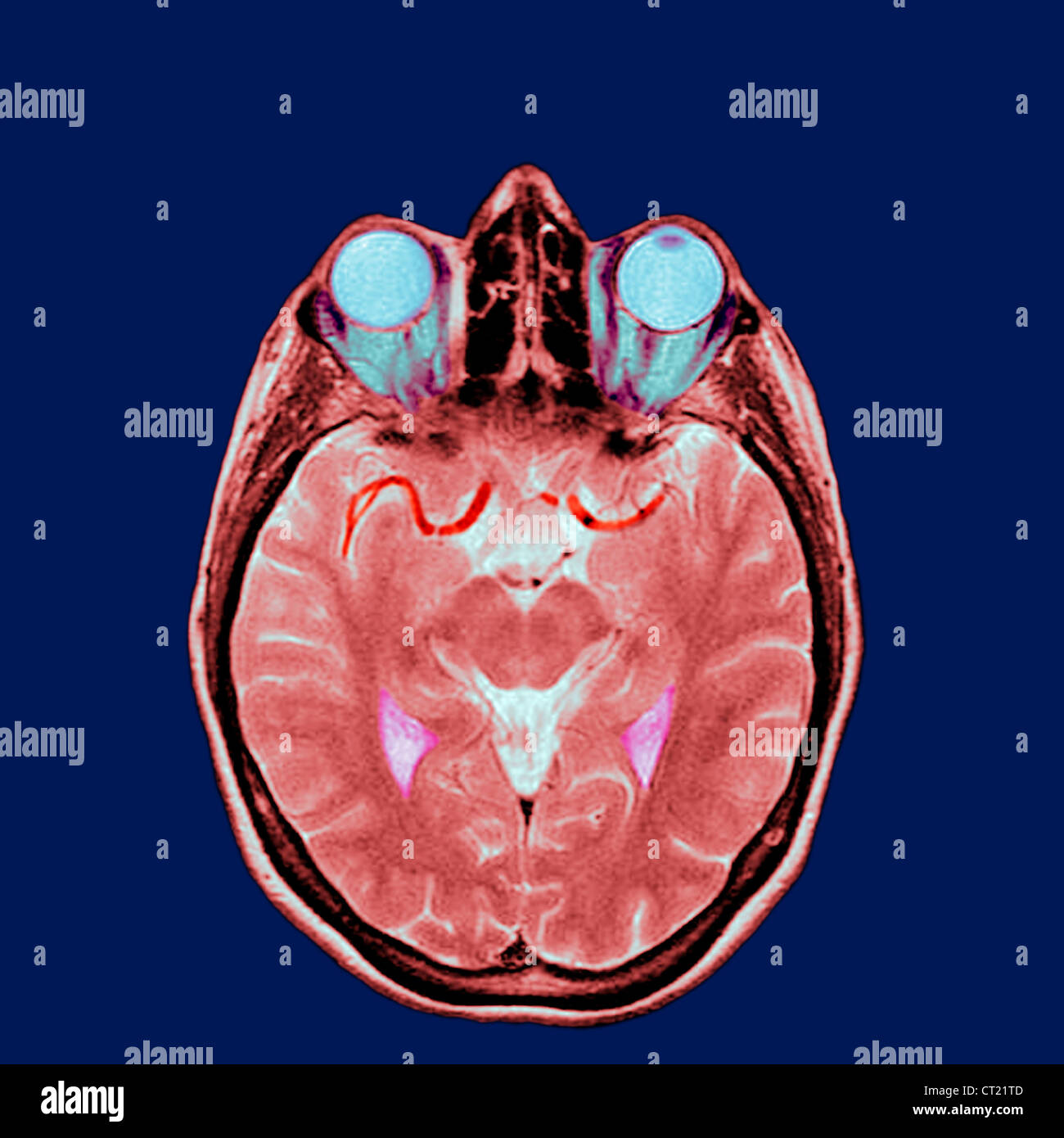 TESTA, MRI Foto Stock