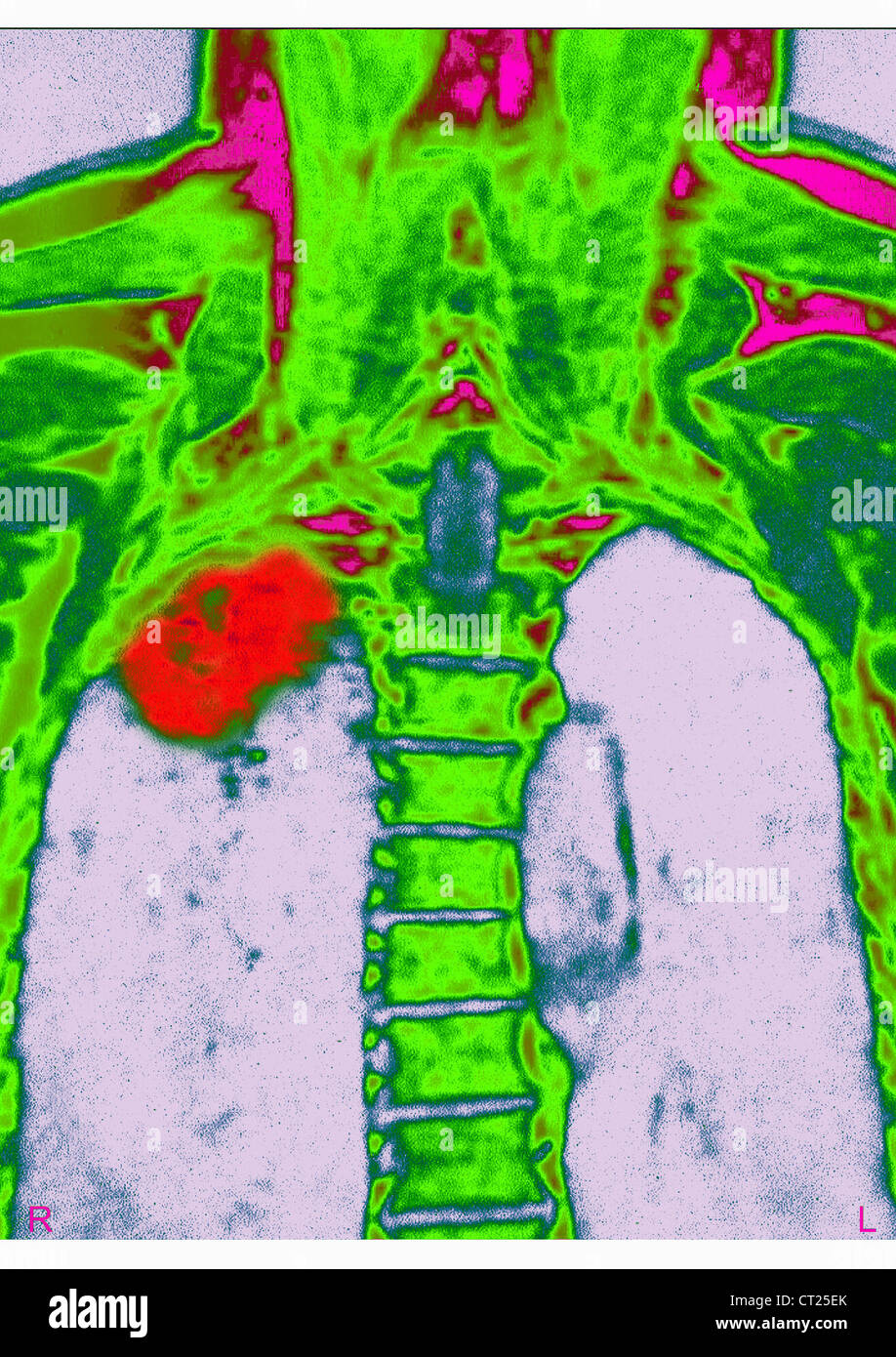 Il cancro del polmone, X-RAY Foto Stock