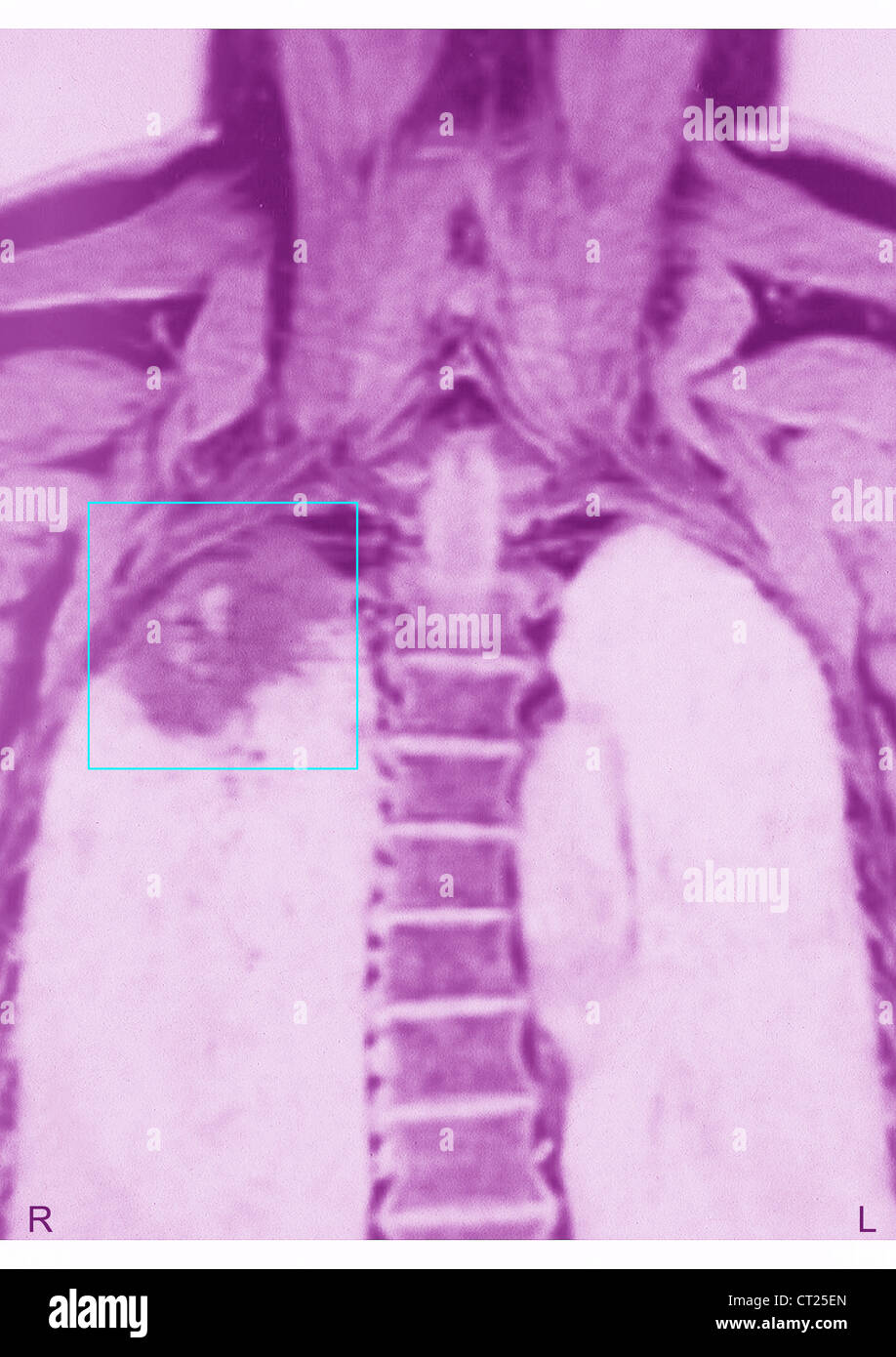 Il cancro del polmone, X-RAY Foto Stock
