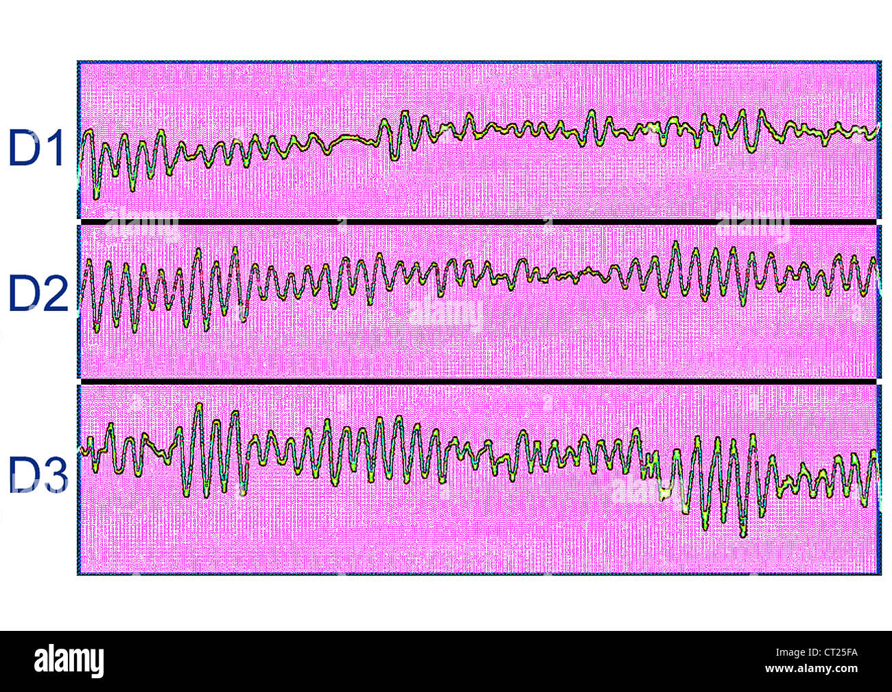La fibrillazione ventricolare, ECG Foto Stock