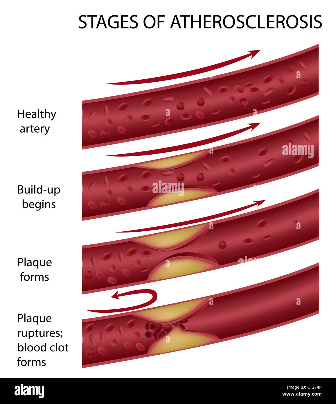 Fasi di arteriosclerosi Foto Stock