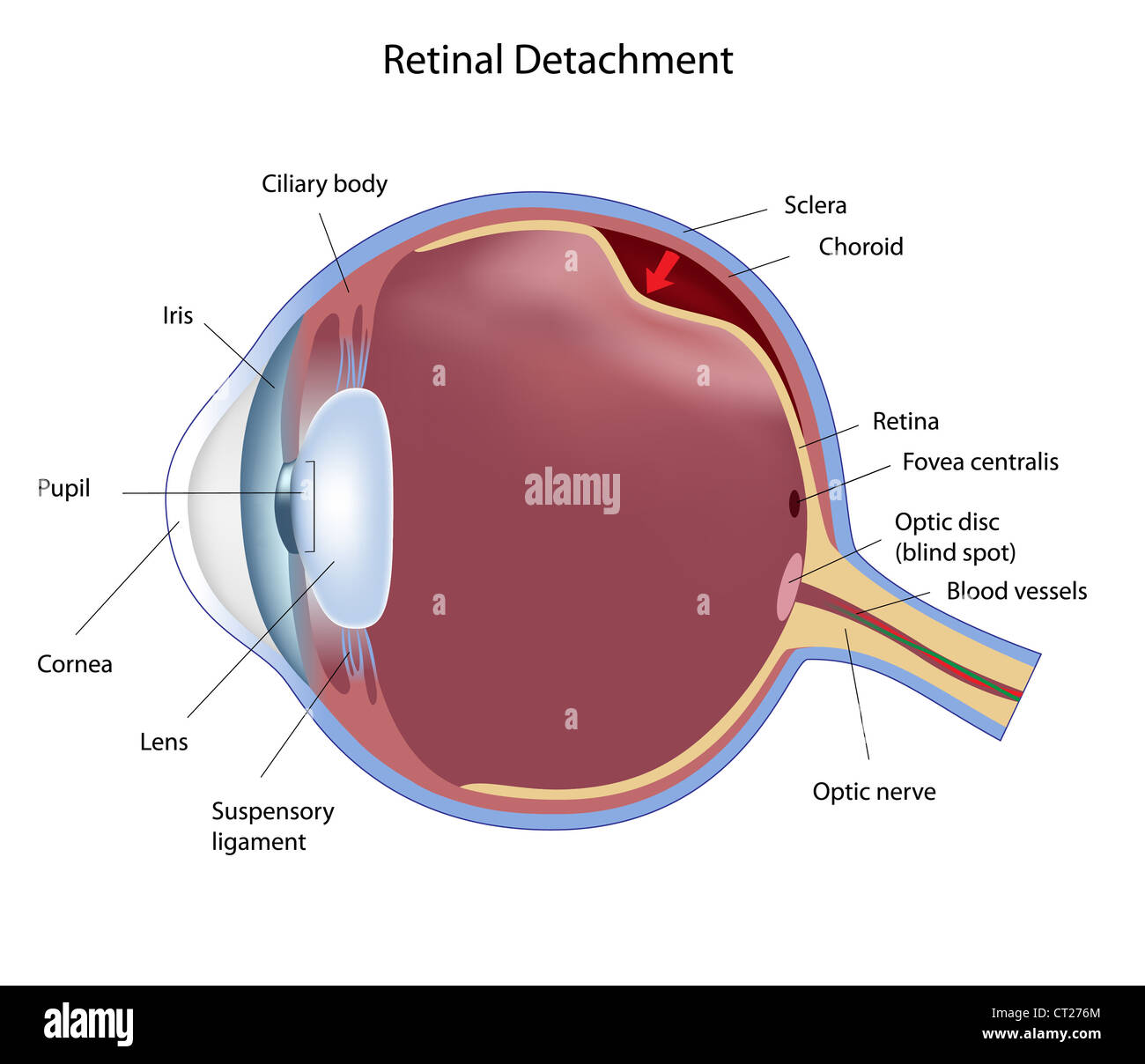 Le malattie degli occhi il distacco della retina Foto Stock