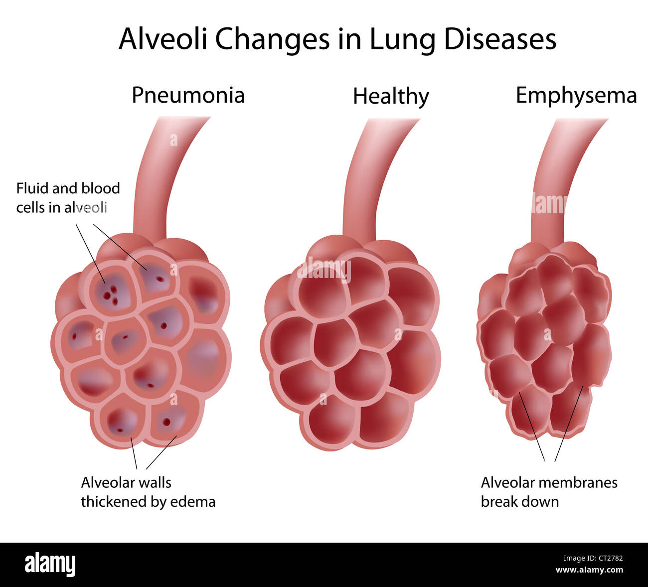 Gli alveoli e le malattie polmonari Foto Stock