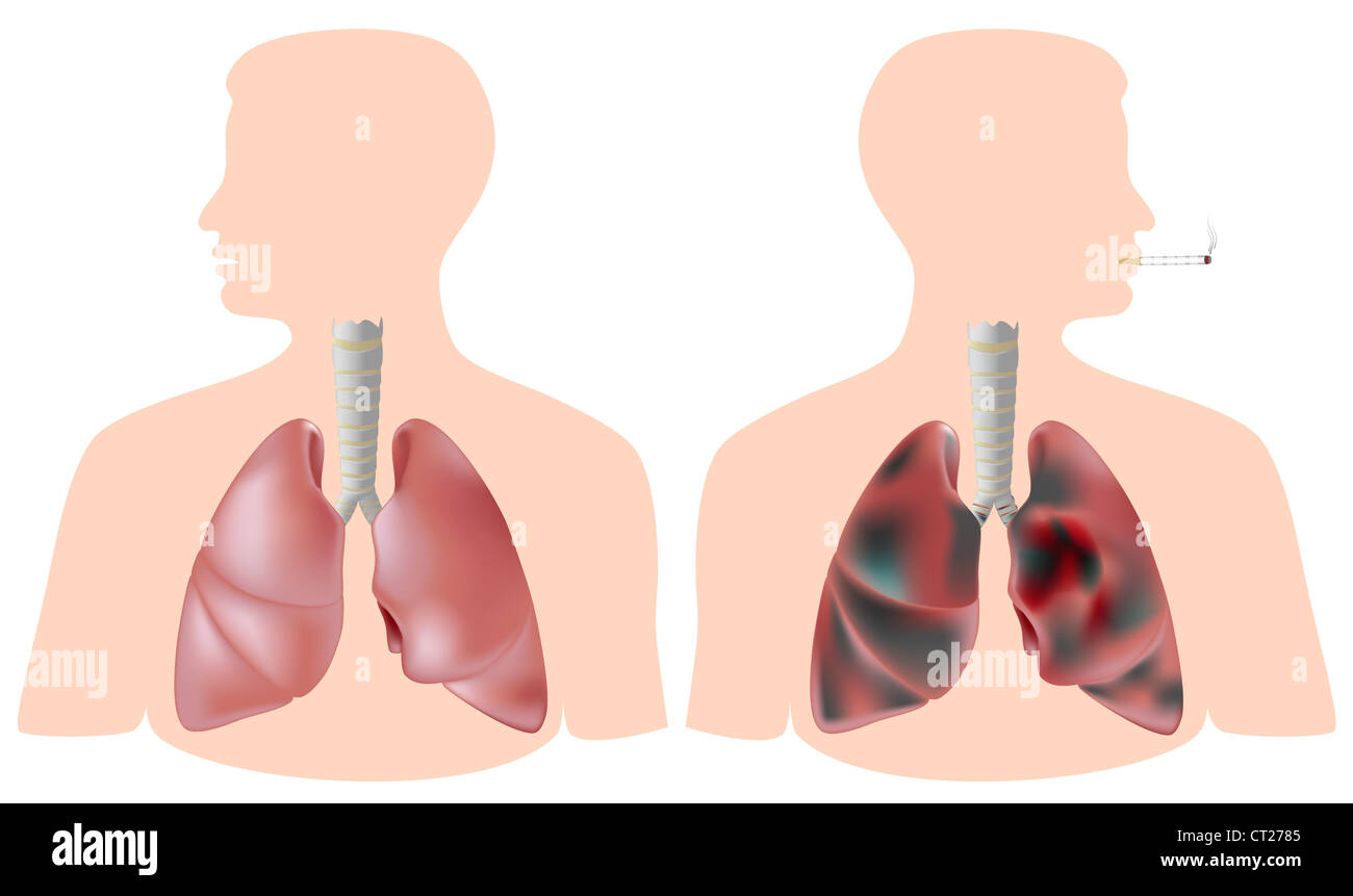 Polmone di fumatore (con tumore) vs polmone sano Foto Stock