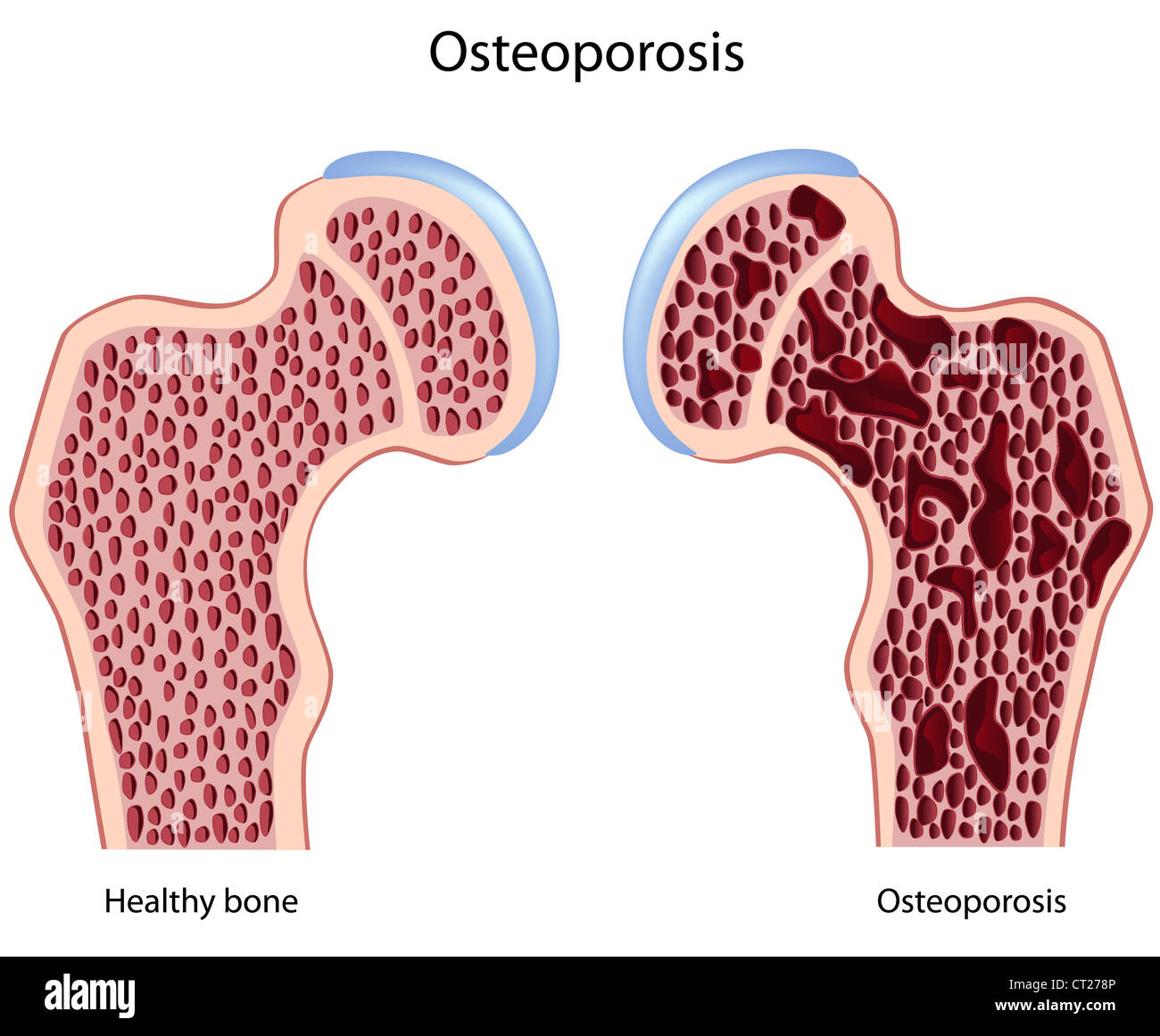 Osteoporosi del femore, osso iliaco Foto Stock