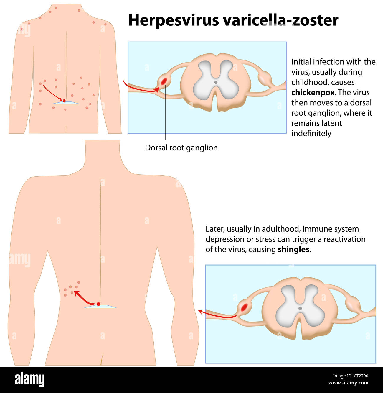 La varicella e herpes zoster Foto Stock