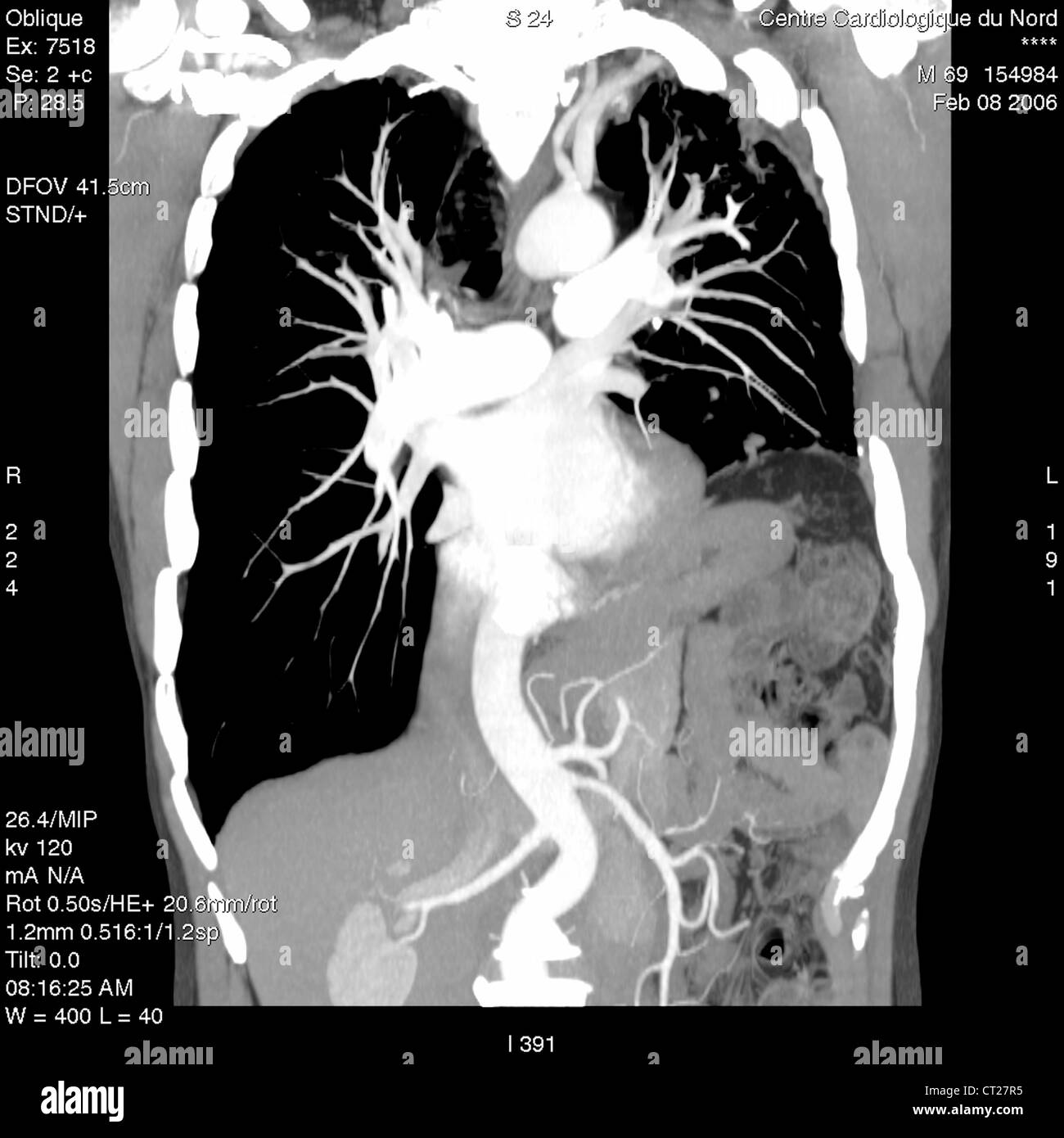 Arteria, angiografia Foto Stock