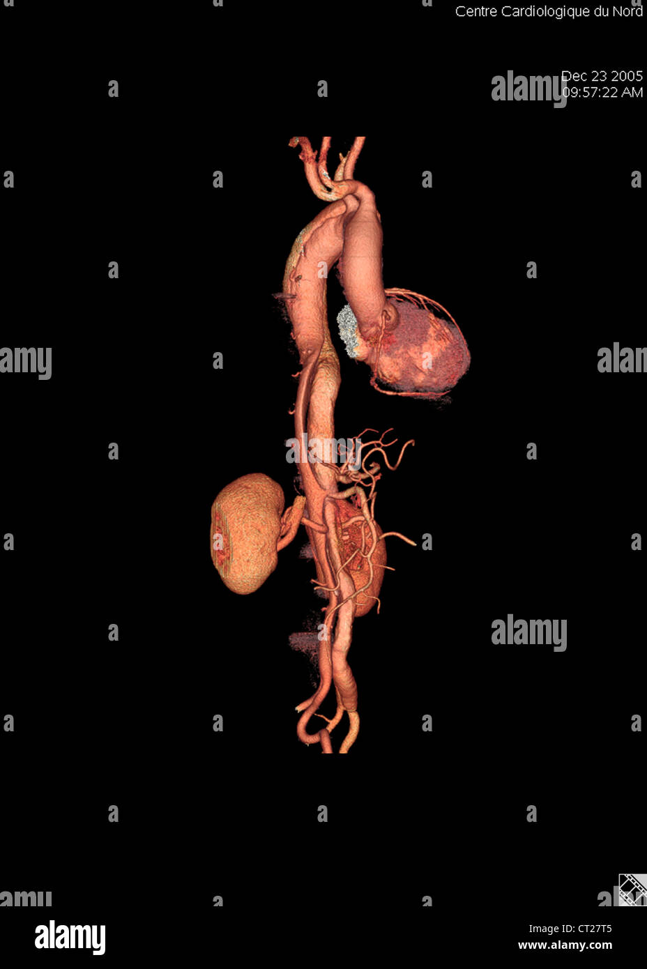 Un aneurisma dell'aorta, 3D SCAN Foto Stock