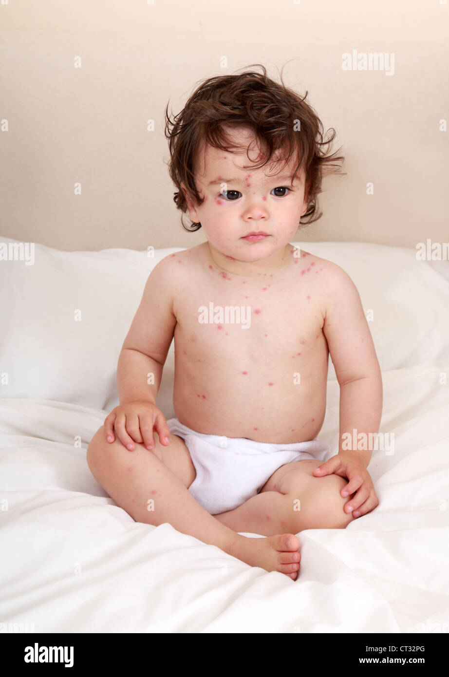 Baby la sofferenza con la varicella rash Foto Stock