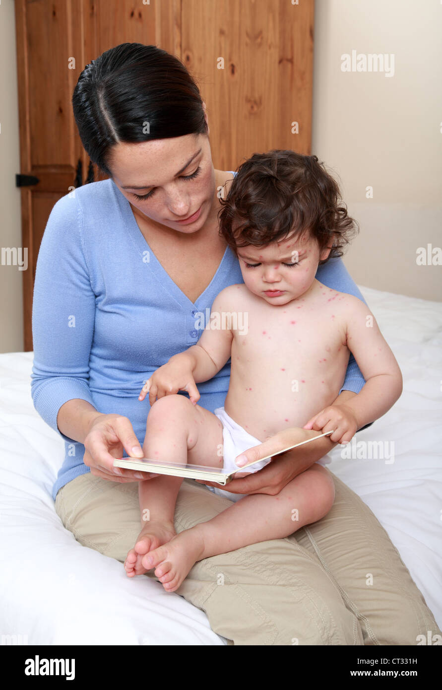 La mamma la lettura al bambino con la varicella Foto Stock