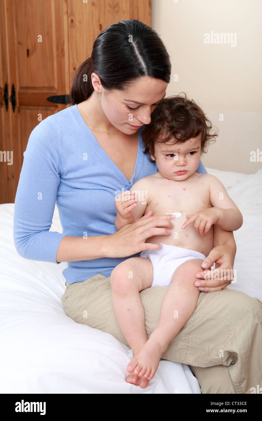 La mamma di applicare la crema per il bambino con la varicella Foto Stock