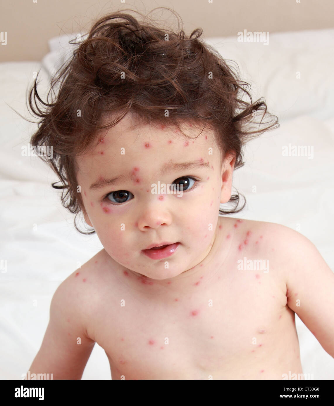 Bambino con la varicella Foto Stock