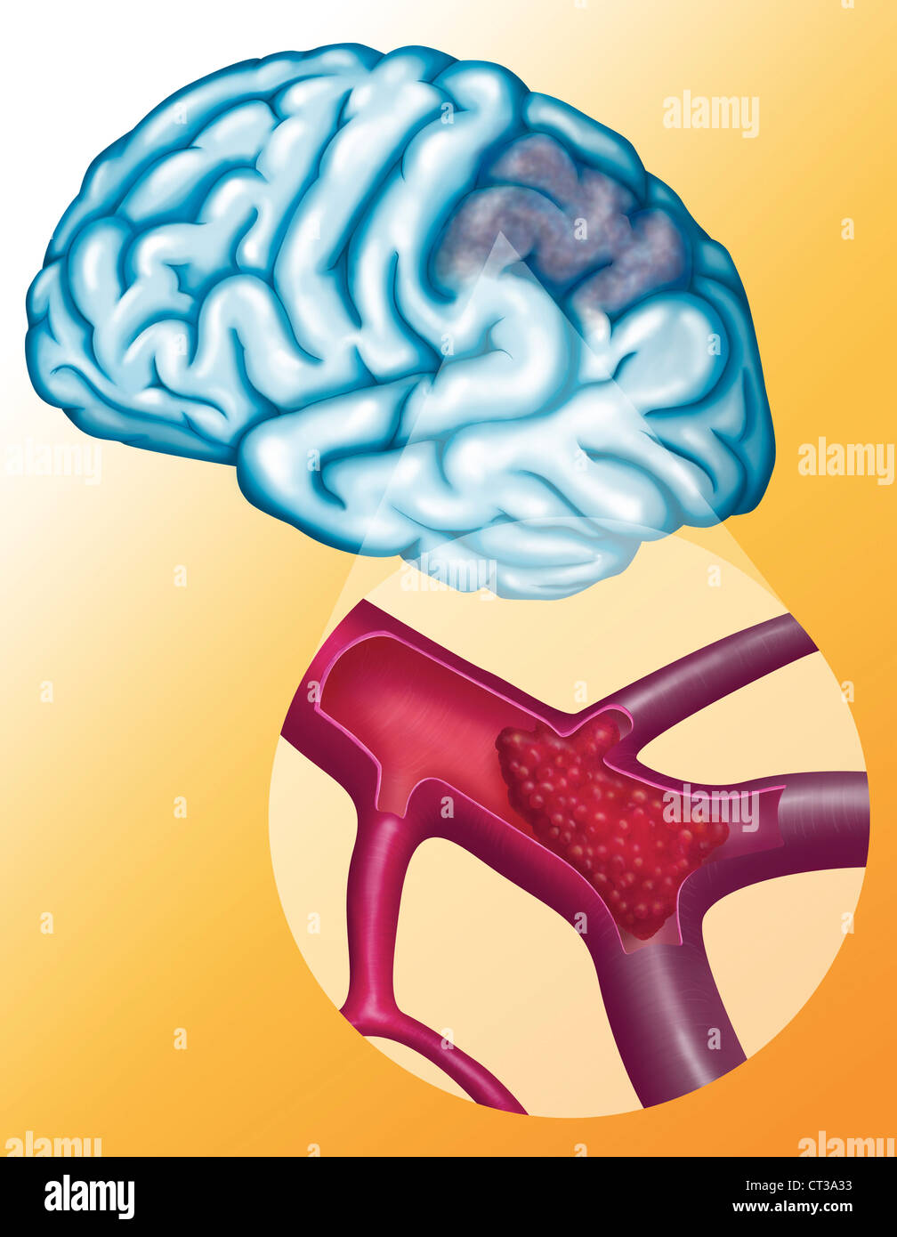 Arteria cerebrale trombosi Foto Stock