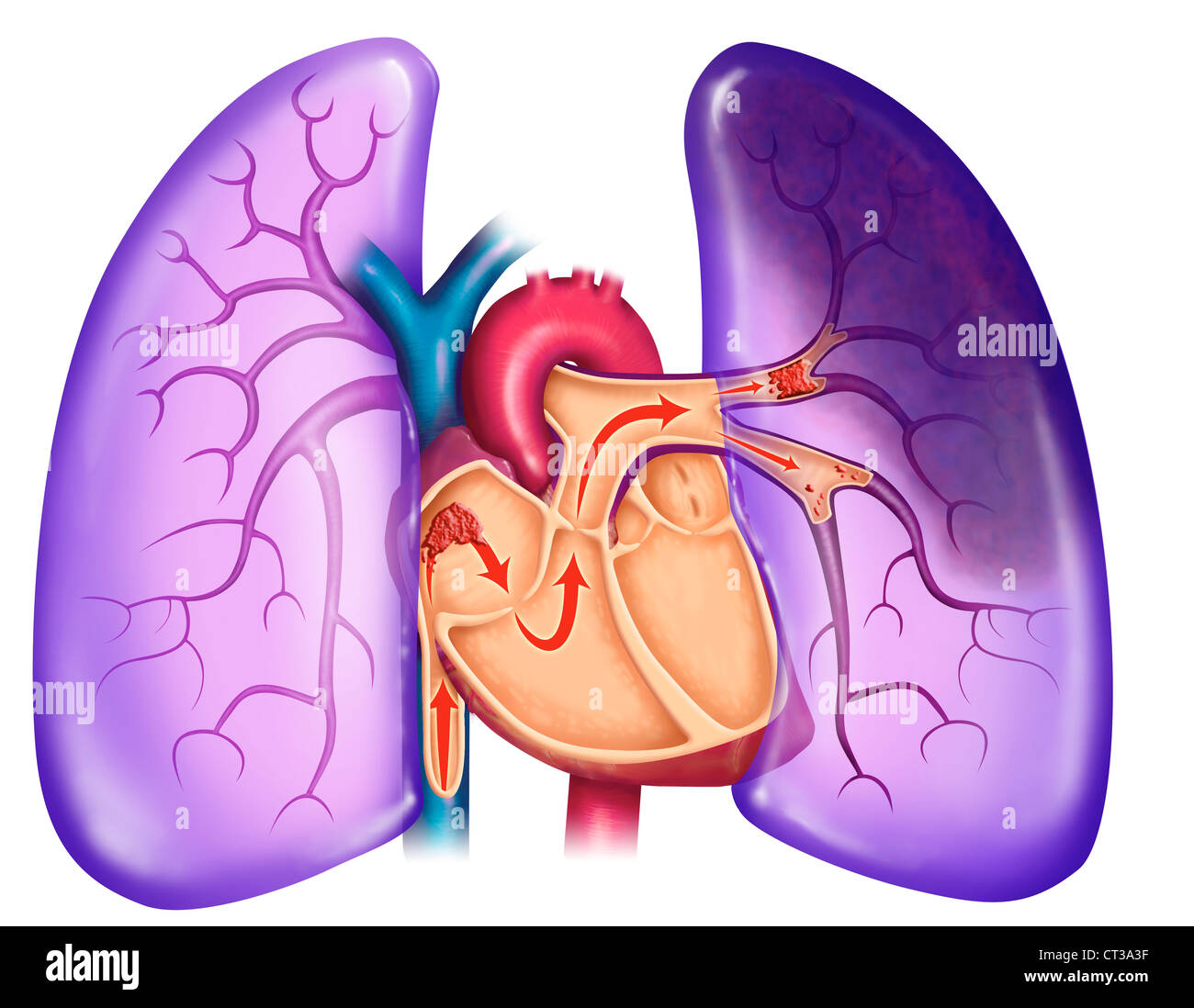 L'embolia polmonare, disegno Foto Stock