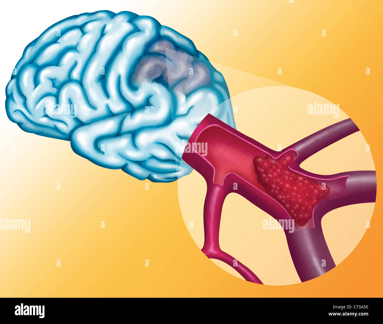 Arteria cerebrale trombosi Foto Stock