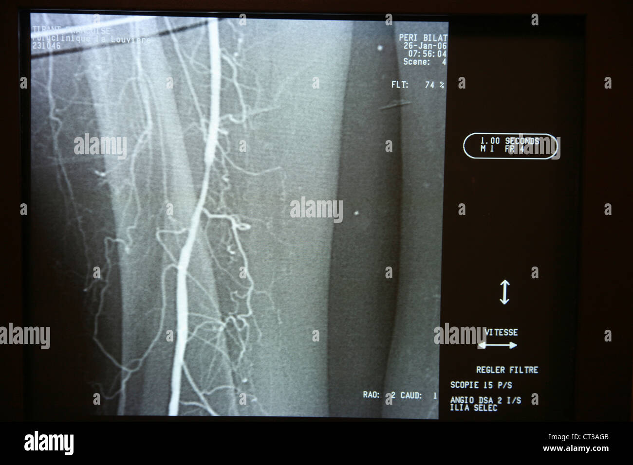 Arto inferiore, ARTERIOGRAPHY Foto Stock