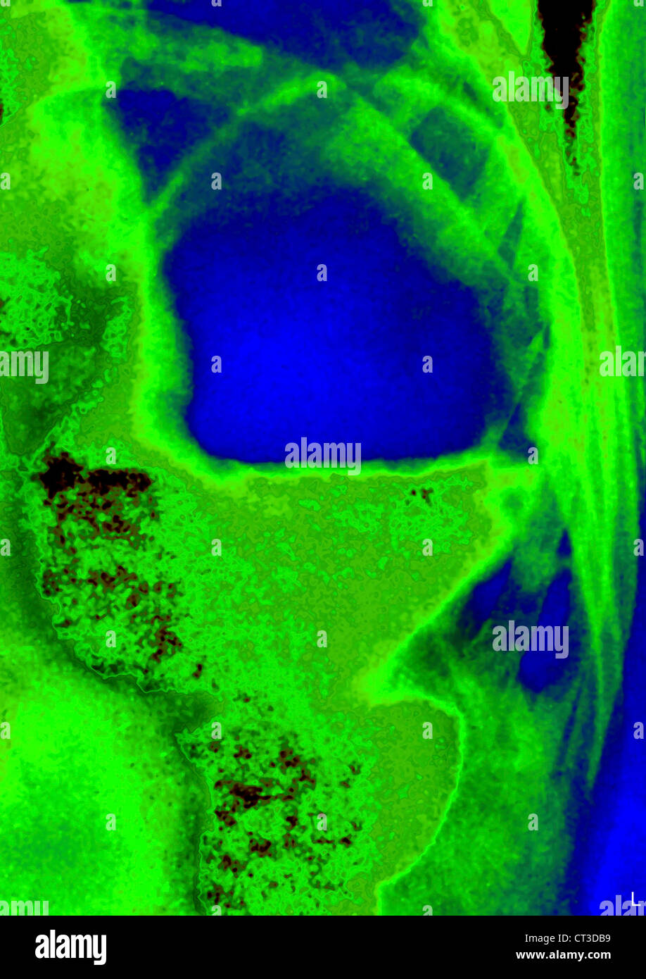 Ernia diaframmatica, X-RAY Foto Stock