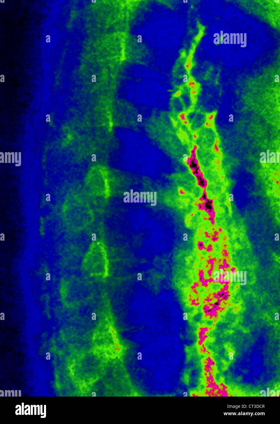 Varice esofagea, X-RAY Foto Stock