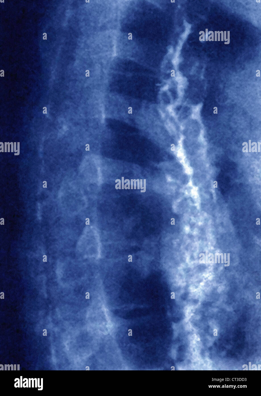 Varice esofagea, X-RAY Foto Stock