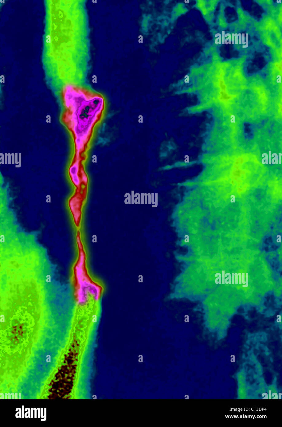 CARCINOMA esofageo, X-RAY Foto Stock