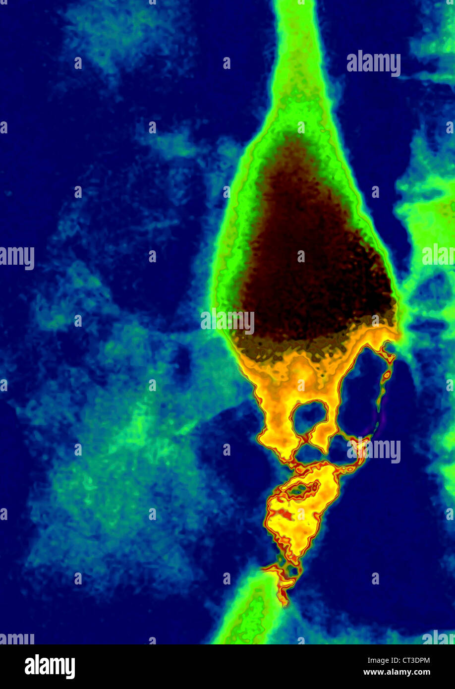 CARCINOMA esofageo, X-RAY Foto Stock