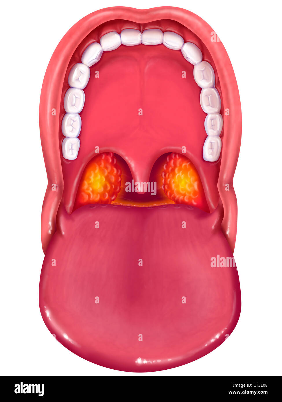 Tonsillite acuta Foto Stock