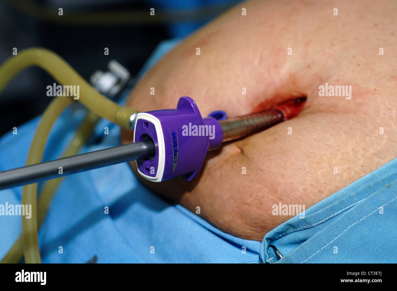 Una porta laparoscopica collocato in un paziente della cavità addominale. In questo modo si gonfiare il ventre con biossido di carbonio. Foto Stock