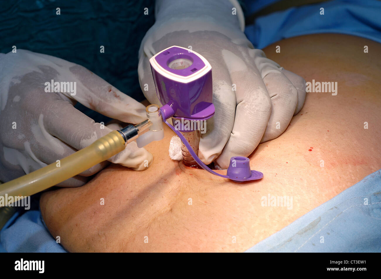 Un tubo di gas è attaccato ad una porta laparoscopica collocato in un paziente della cavità addominale. In questo modo si gonfiare il ventre con biossido di carbonio. Foto Stock