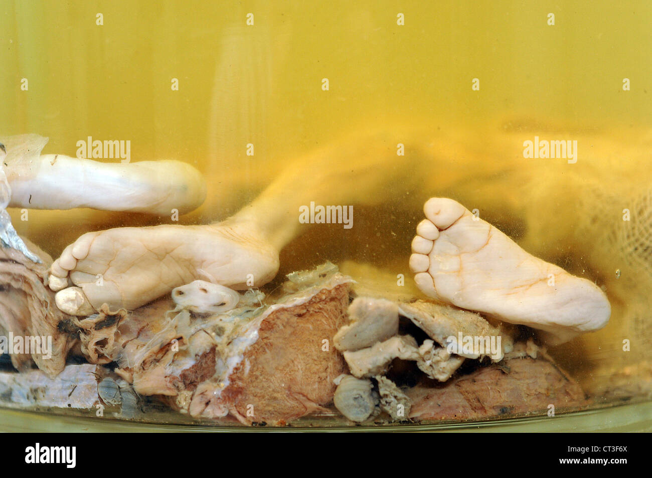 Le gambe di un feto morto conservato in formaldeide. Foto Stock