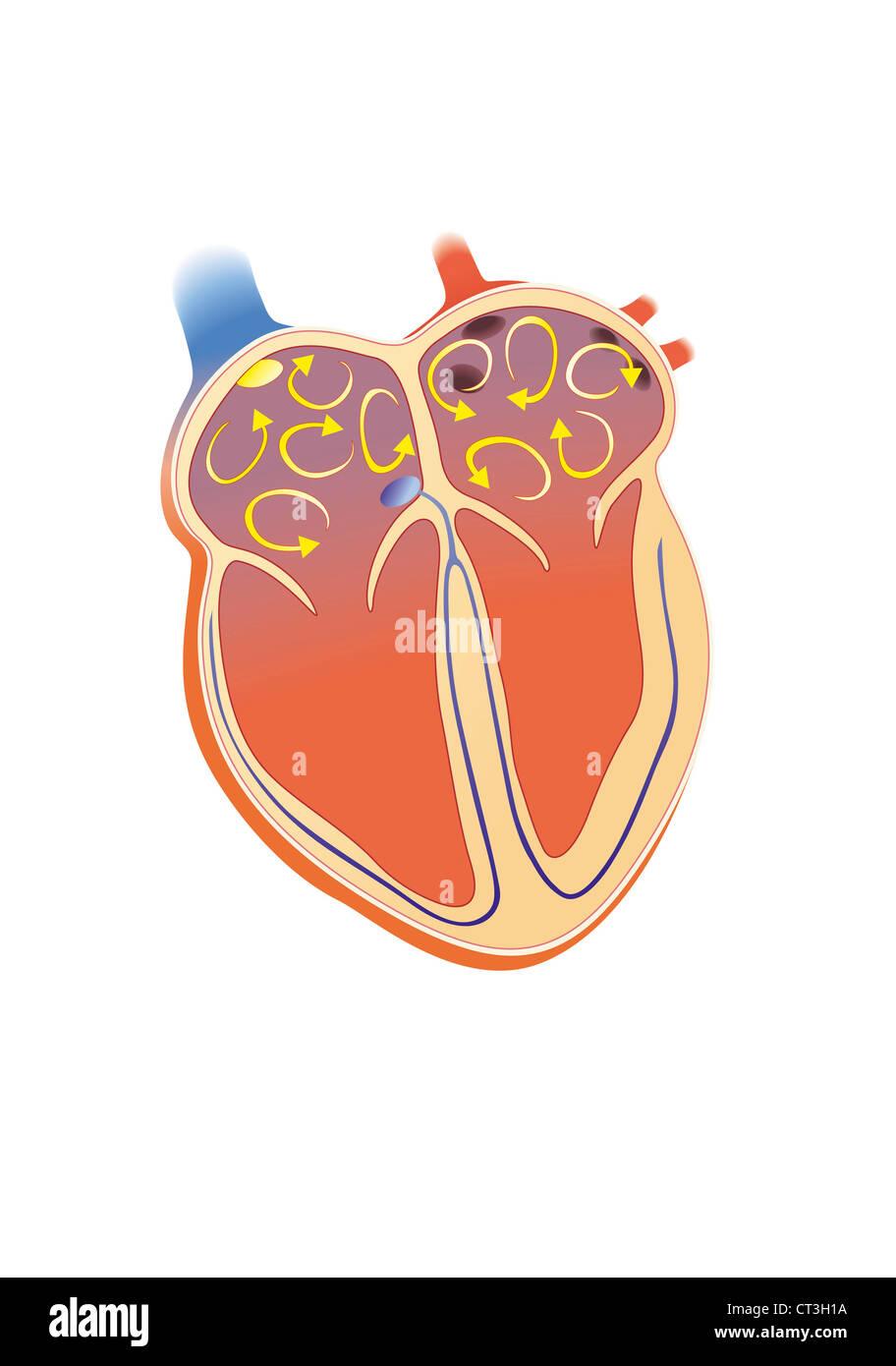 Cuore fibrillazione, illustrazione Foto Stock