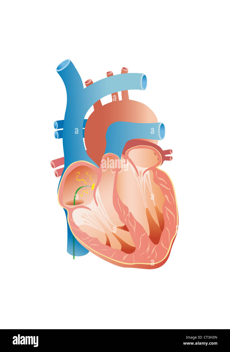 Ablazione a radiofrequenza Foto Stock