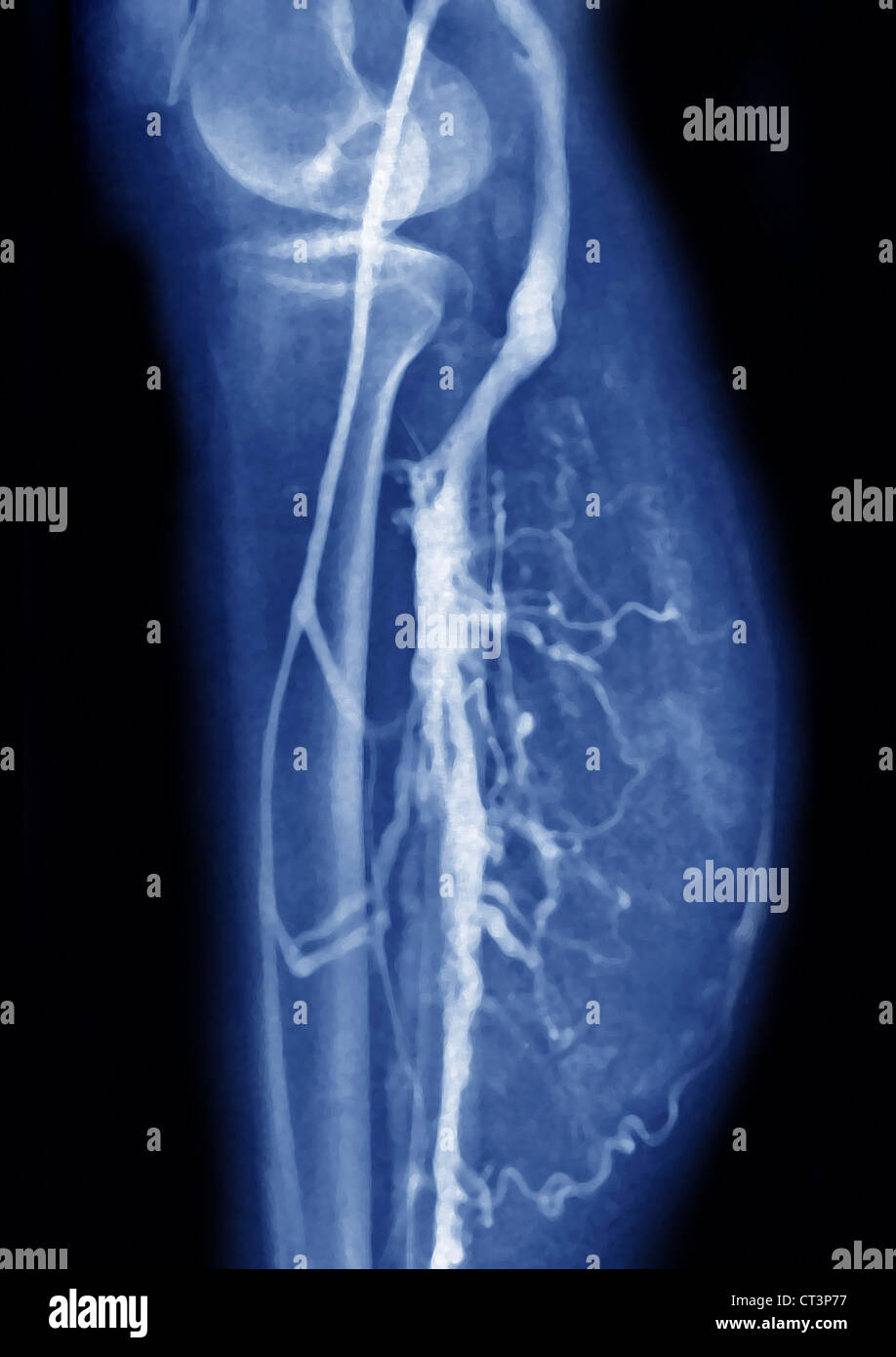 Arto inferiore, angiografia Foto Stock