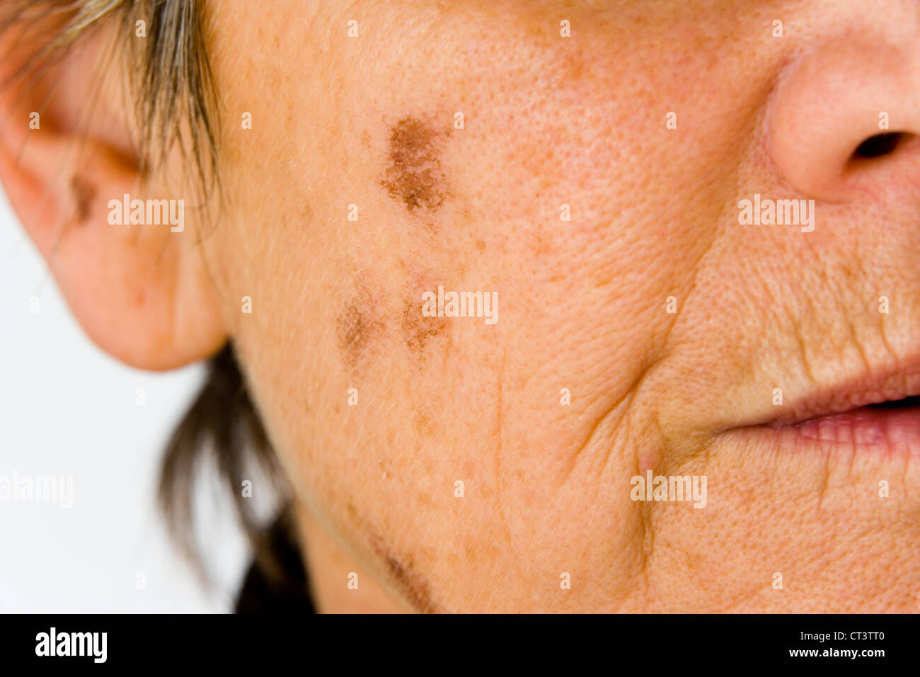 Dermatologia, IL TRATTAMENTO DI PERSONE ANZIANE P. Foto Stock