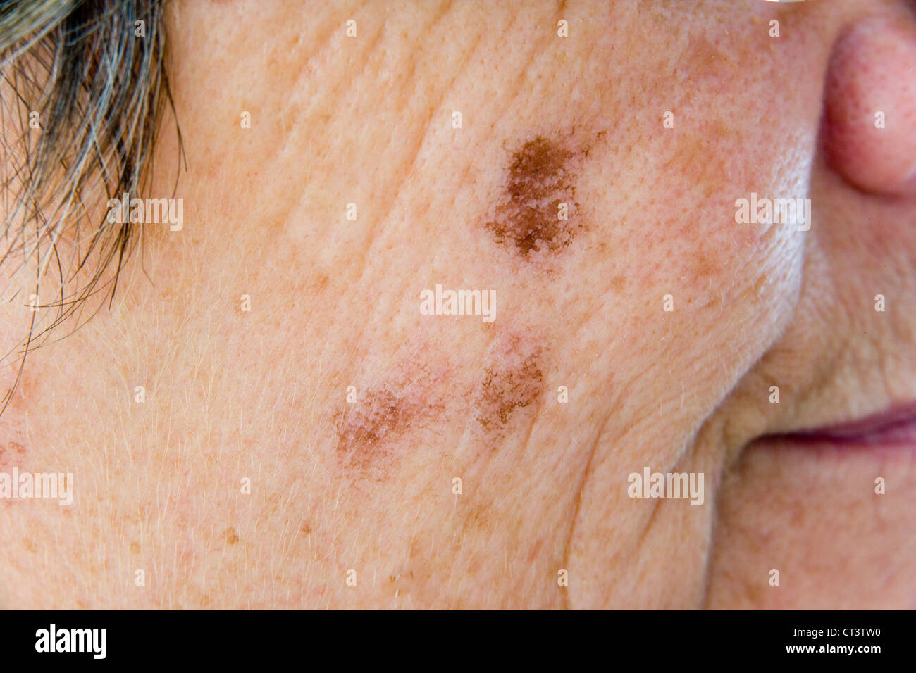 Dermatologia, IL TRATTAMENTO DI PERSONE ANZIANE P. Foto Stock